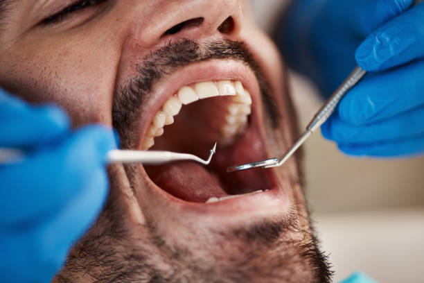 Best Emergency Dentist for Knocked-Out Tooth in Mission, OR
