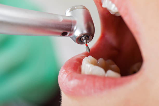 Best Broken or Cracked Tooth Emergency Dentist in Mission, OR